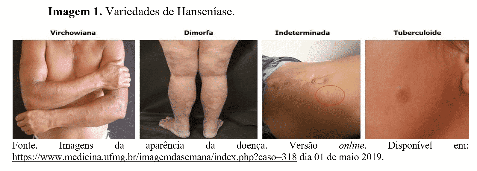 Espessamento De Paredes Brônquicas O Que é